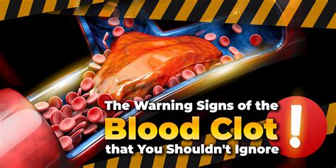 clots citi|6 Blood Clot Signs You Shouldn't Ignore .